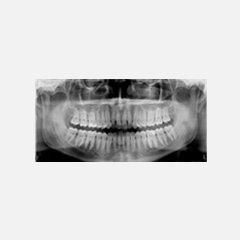 Ortopantomografia. Radiografia panoramica delle arcate dentarie.