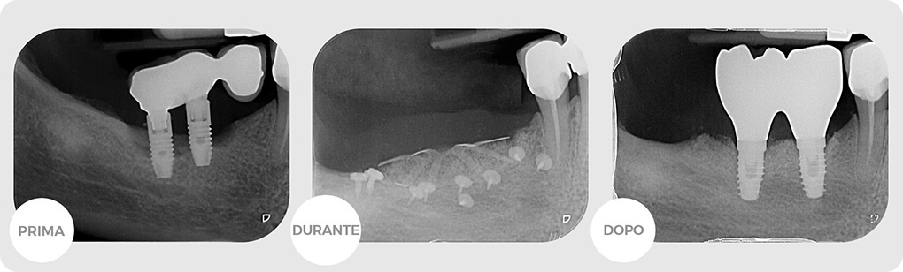 Centro Medico Reno. Casi clinici: Chirurgia Ossea Rigenerativa.