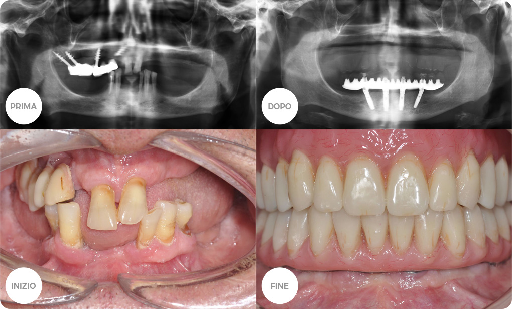 Centro Medico Reno. Casi clinici: Implantologia Complessa.