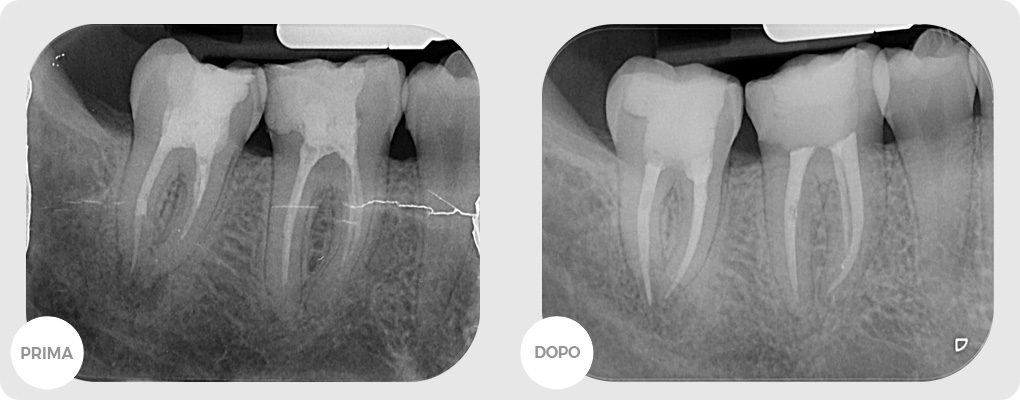 Centro Medico Reno. Casi clinici: Endodonzia.