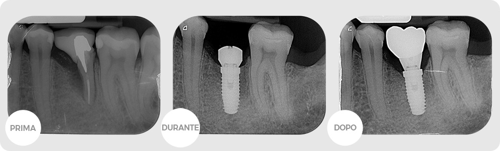 Centro Medico Reno. Casi clinici: Implantologia Semplice.