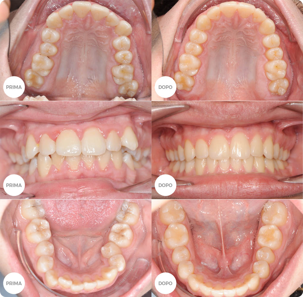 Centro Medico Reno. Casi clinici: ortodonzia
