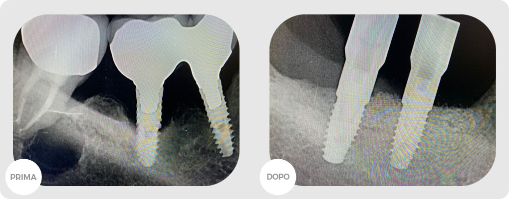 Casi clinici: Insuccessi CH/ Implantari e rigenerazione centro medico reno