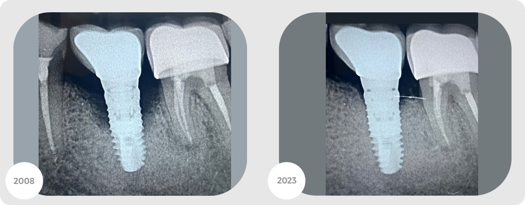 Perimplantite-centro-medico-reno