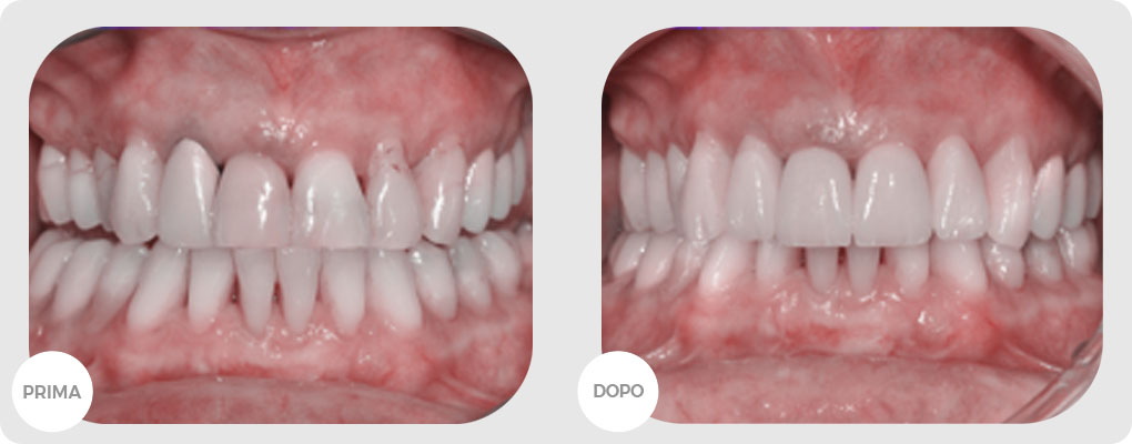 corone-zirconia-centro-medico-reno